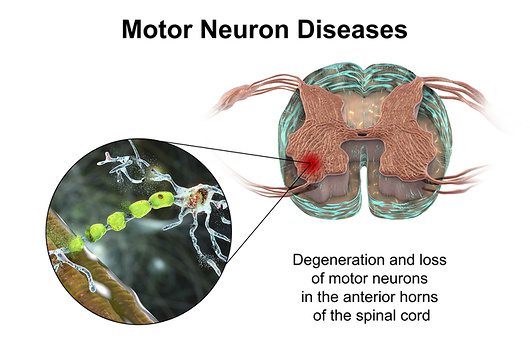 Illustration of motor neuron diseases, showing degeneration of motor neurons in anterior horns of spinal cord.
